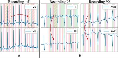 Generalising electrocardiogram detection and delineation: training convolutional neural networks with synthetic data augmentation